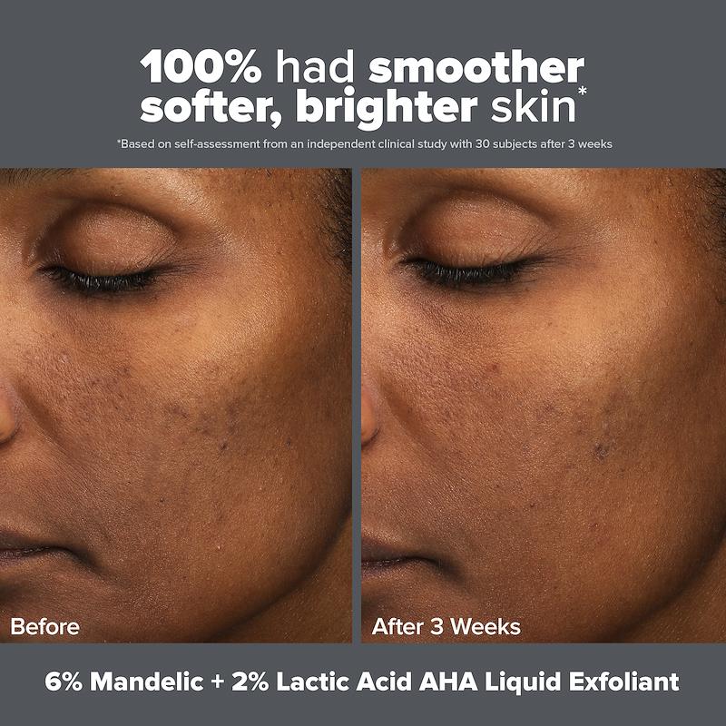 Paula's Choice Skin Perfecting 6% Mandelic 2% Lactic Liquid Exfoliant