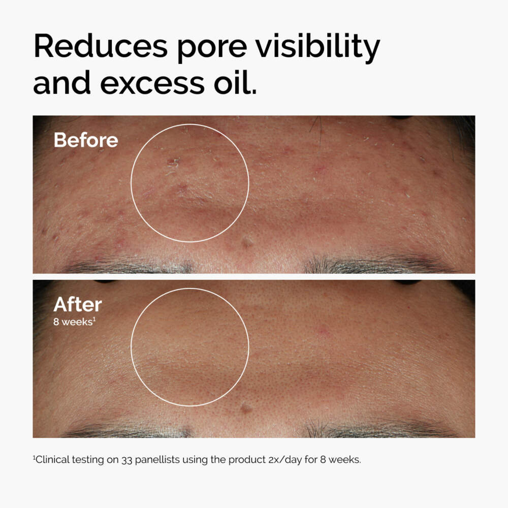 The Ordinary Niacinamide 10% + Zinc 1% Face Serum